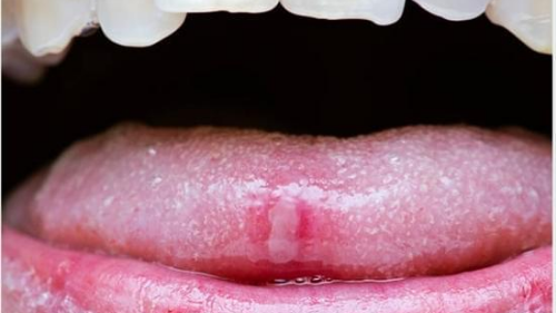 أعراض قرح الفم وعلاجها